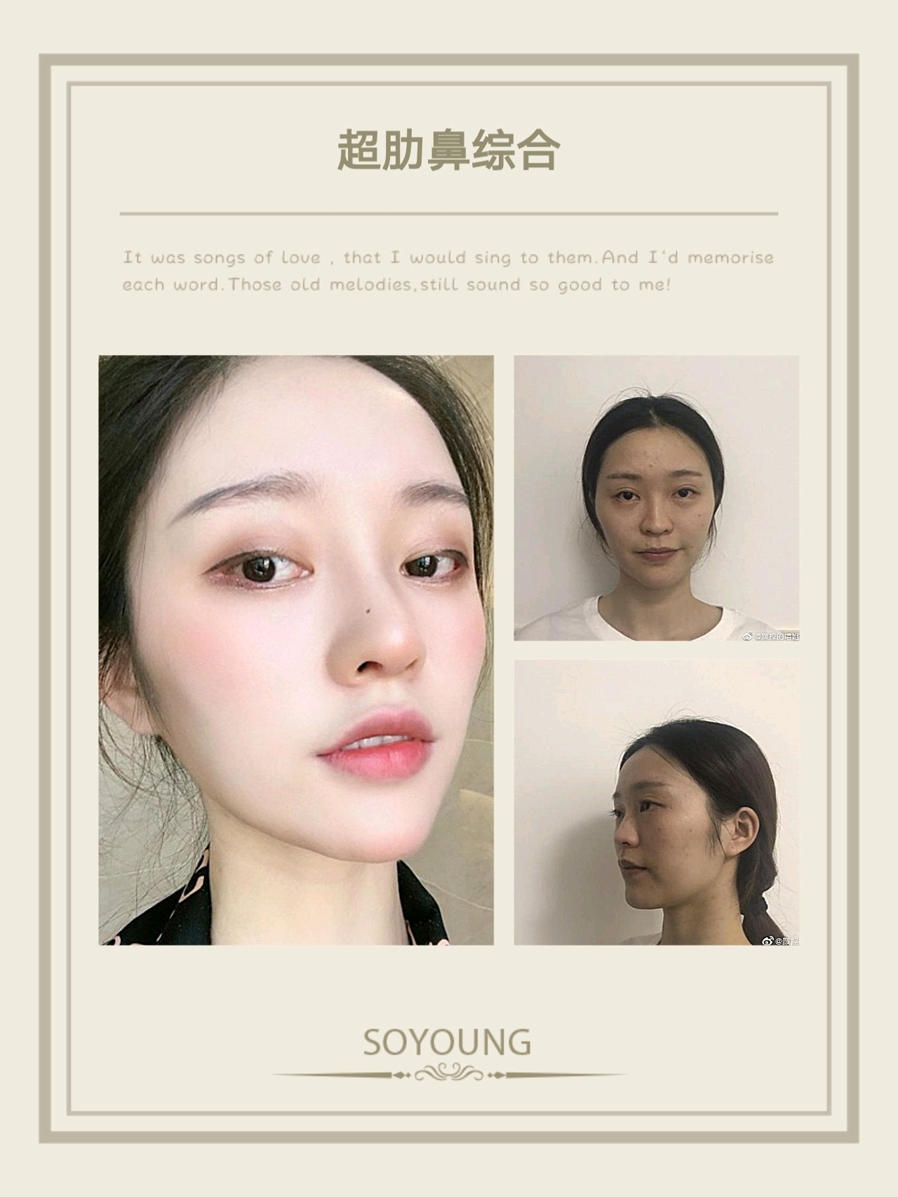 鼻子很明显就是没有立体感,做了超肋隆鼻,鼻子精致有_圈子-新氧美容