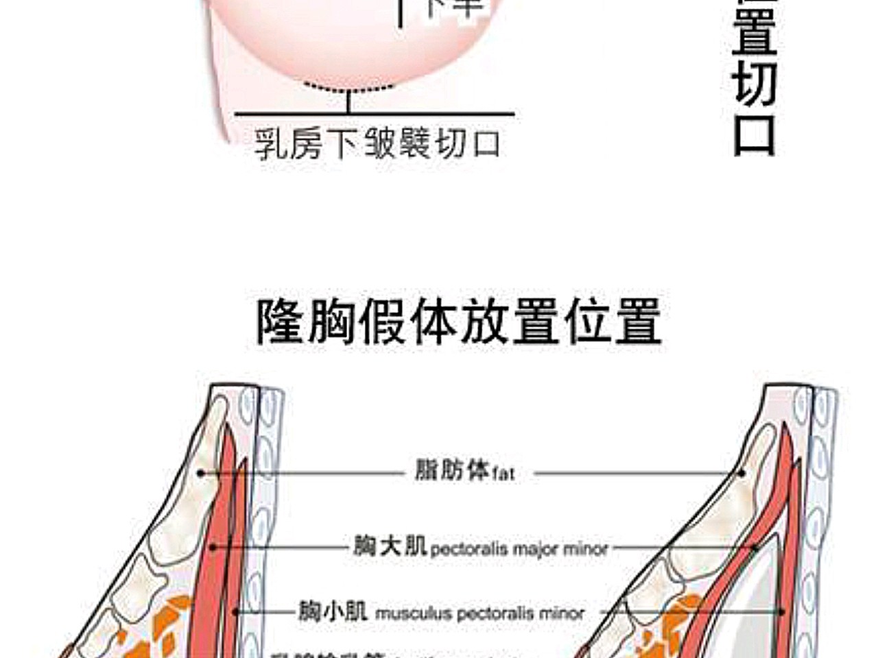 3.乳房下皱襞切口,长度为2-4cm,也有医生将切口缩短到2-2.5cm.