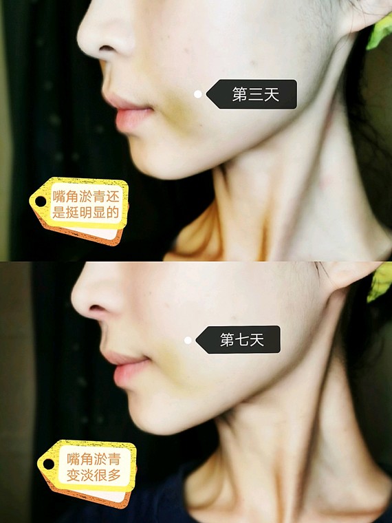 fillmed玻尿酸鼻基底填充一周恢复效果!00.99