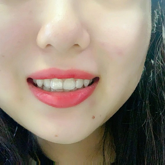 昨天是第一副隐形牙套的最后一天我一直都知道隐适美