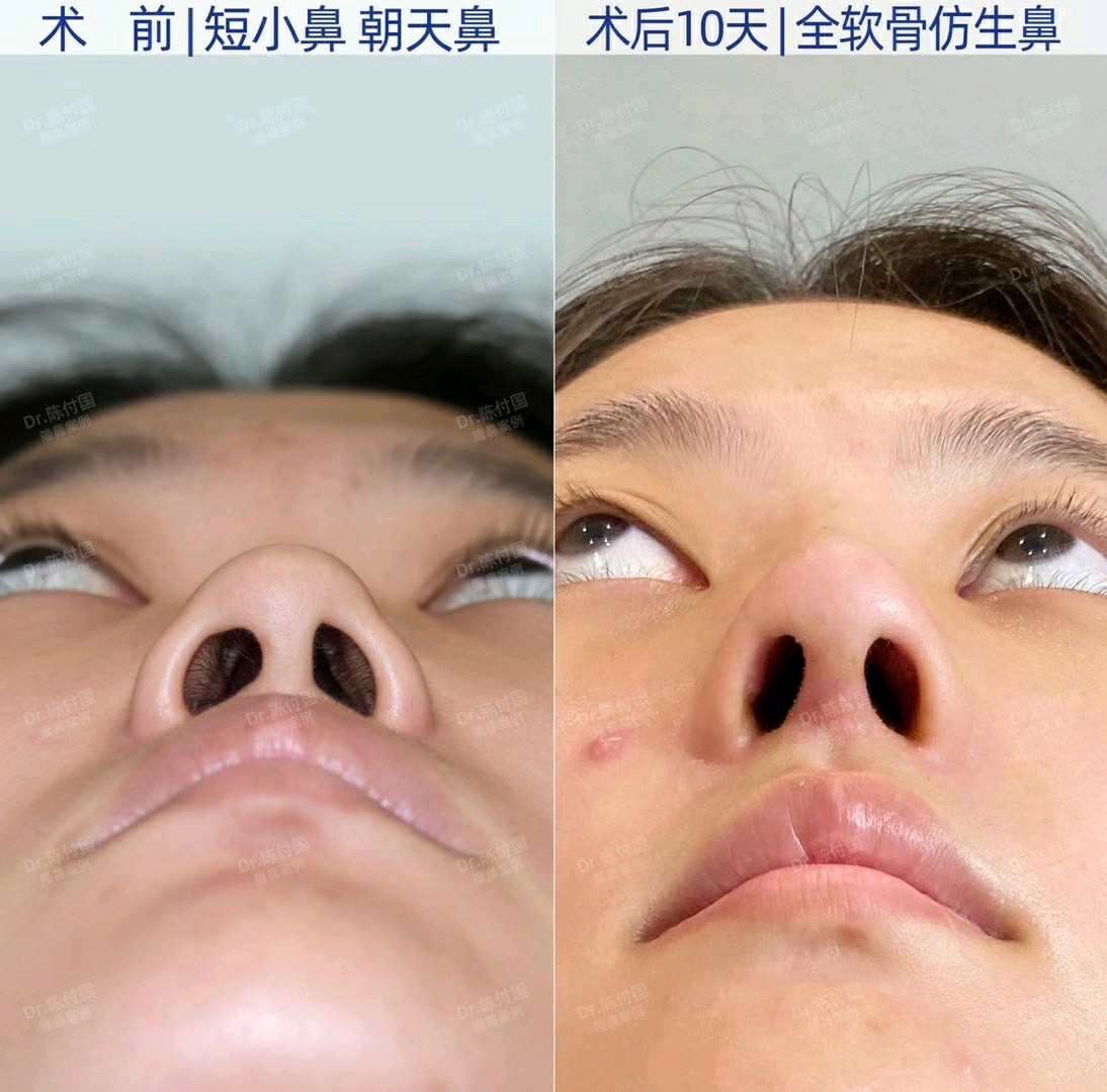 全软骨综合鼻 | 鼻背软骨轻微垫高,整体延长,主要