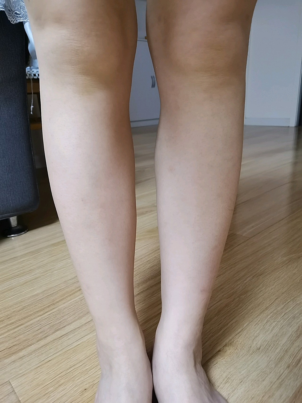 打了300u的瘦腿针,打之前觉得打完以后应该会成小细腿了,结果发现并不