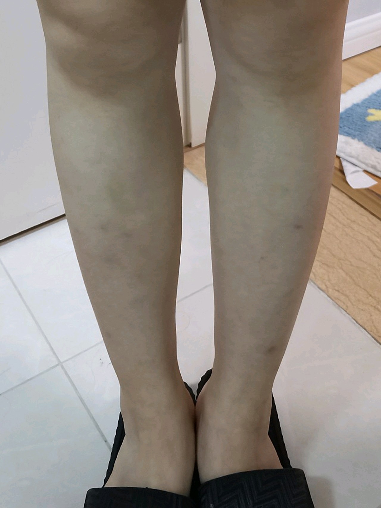 打了300u的瘦腿针,打之前觉得打完以后应该会成小细腿了,结果发现并不