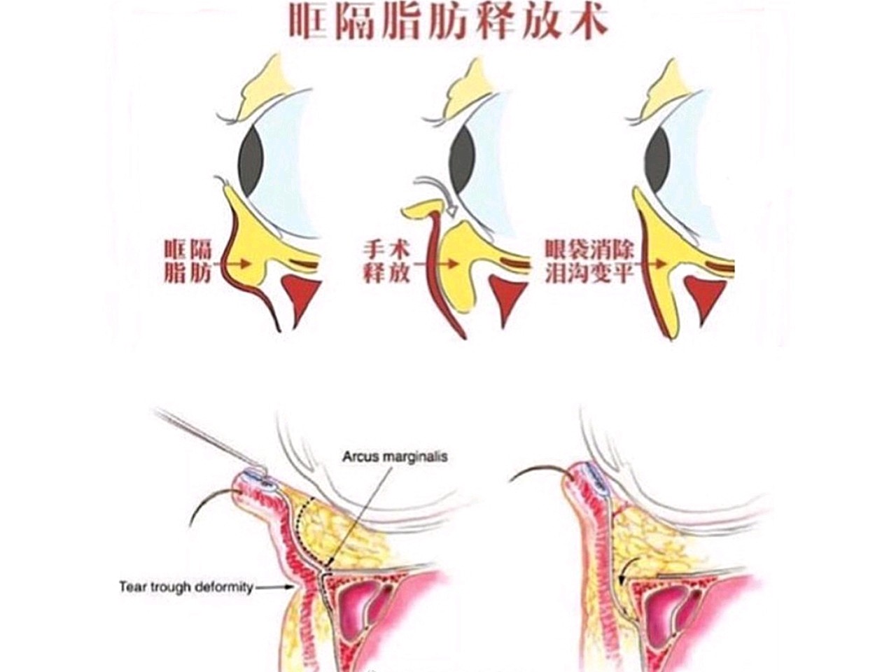 眼袋对容貌有很大的影响,它不仅使人显老,严重的还会由于眶隔膜的松弛