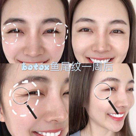 打除皱针脸会变僵硬吗?