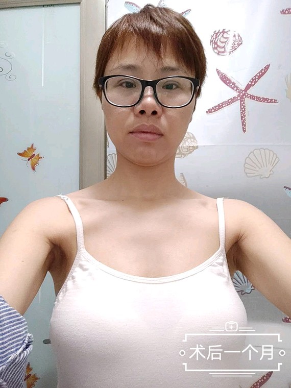 重庆探店-自体脂肪丰胸—平胸妹子逆袭c杯波霸!
