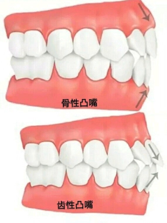 牙性凸嘴只需要牙齿矫正即可;骨性凸嘴大多要进行正颌