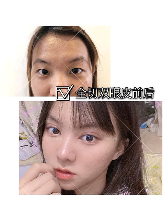 35 难逃的眼皮松弛,凹陷?该怎样无痕衔接变柔和有神?