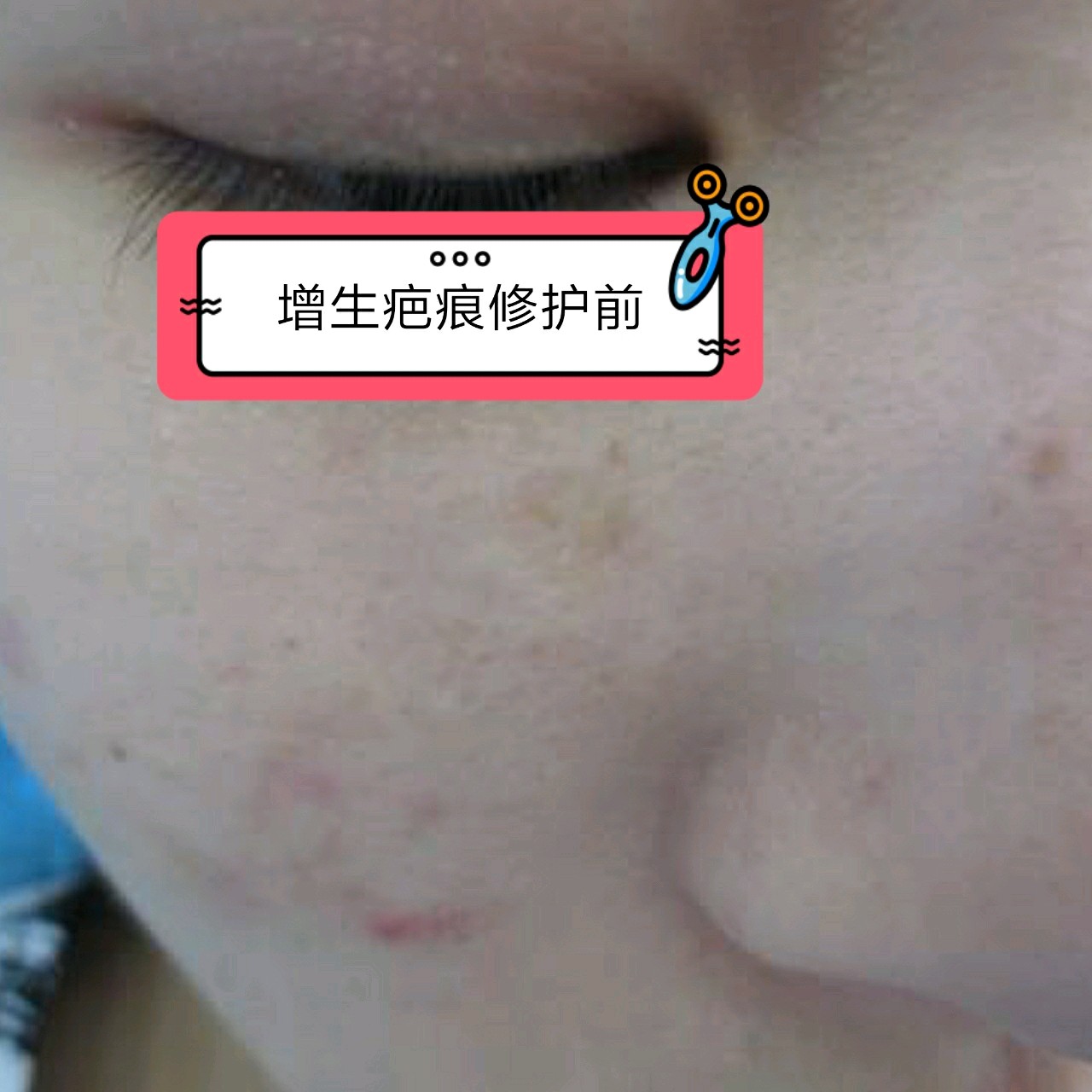 脸上的增生疤痕是因为激光点痣,在点痣之后就出现了增