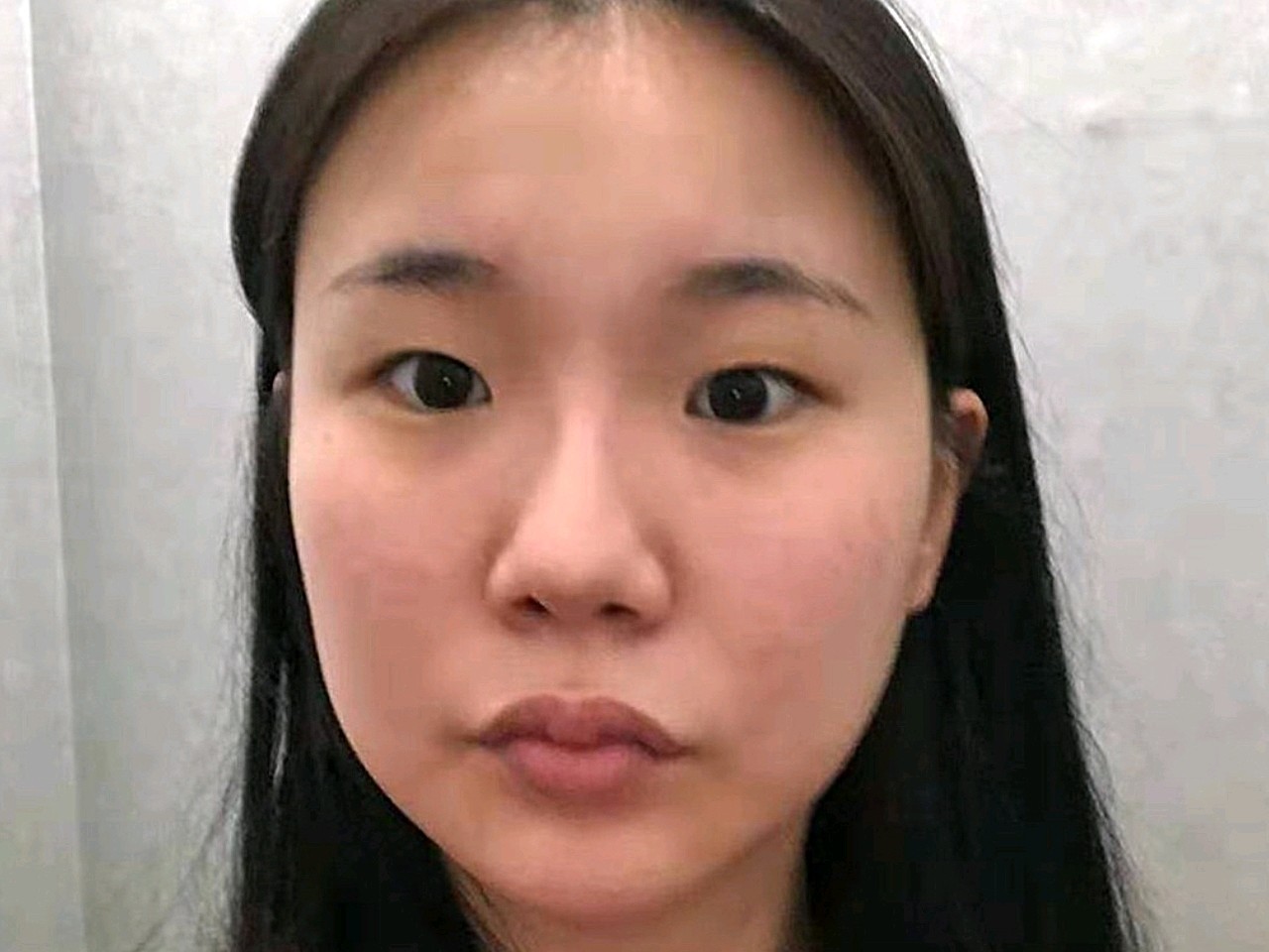 天生的单眼皮小圆眼,一直想做双眼皮,但苦于找不到好_圈子-新氧美容