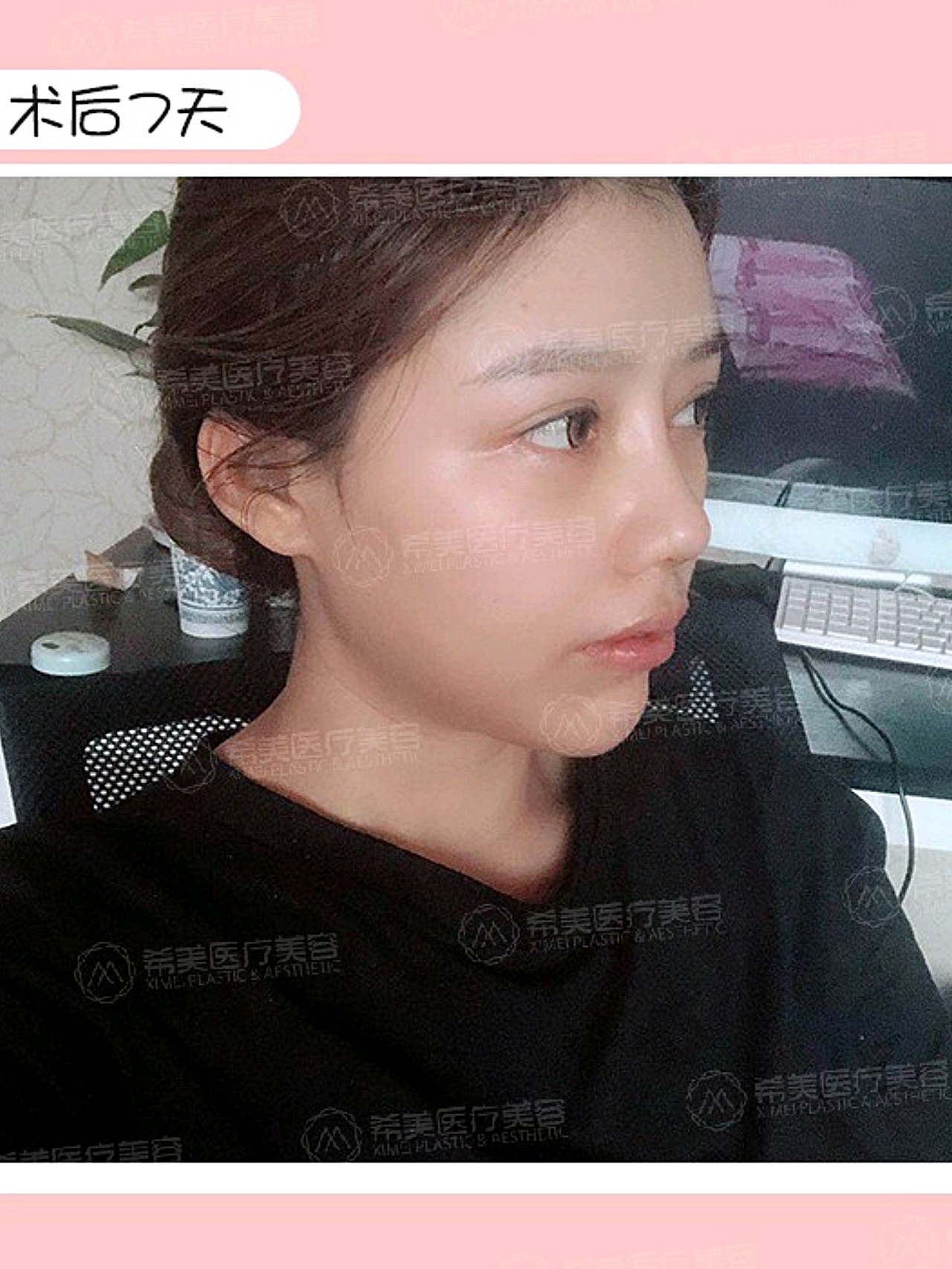 关于超体隆鼻,你了解多少?