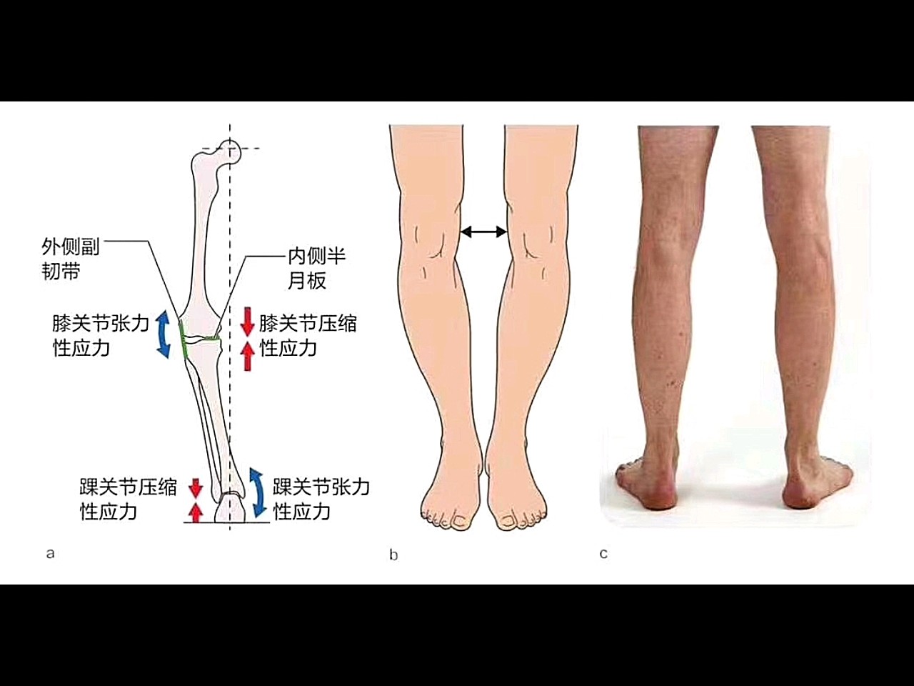 膝内翻通常又称为"o形腿",膝关节内翻使胫股关节的内角小于180度.