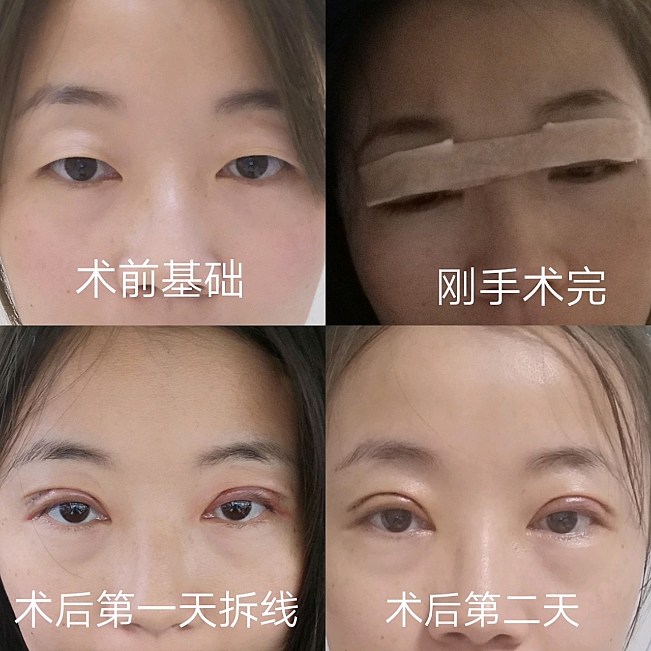 长沙全切双眼皮术后七天恢复记录