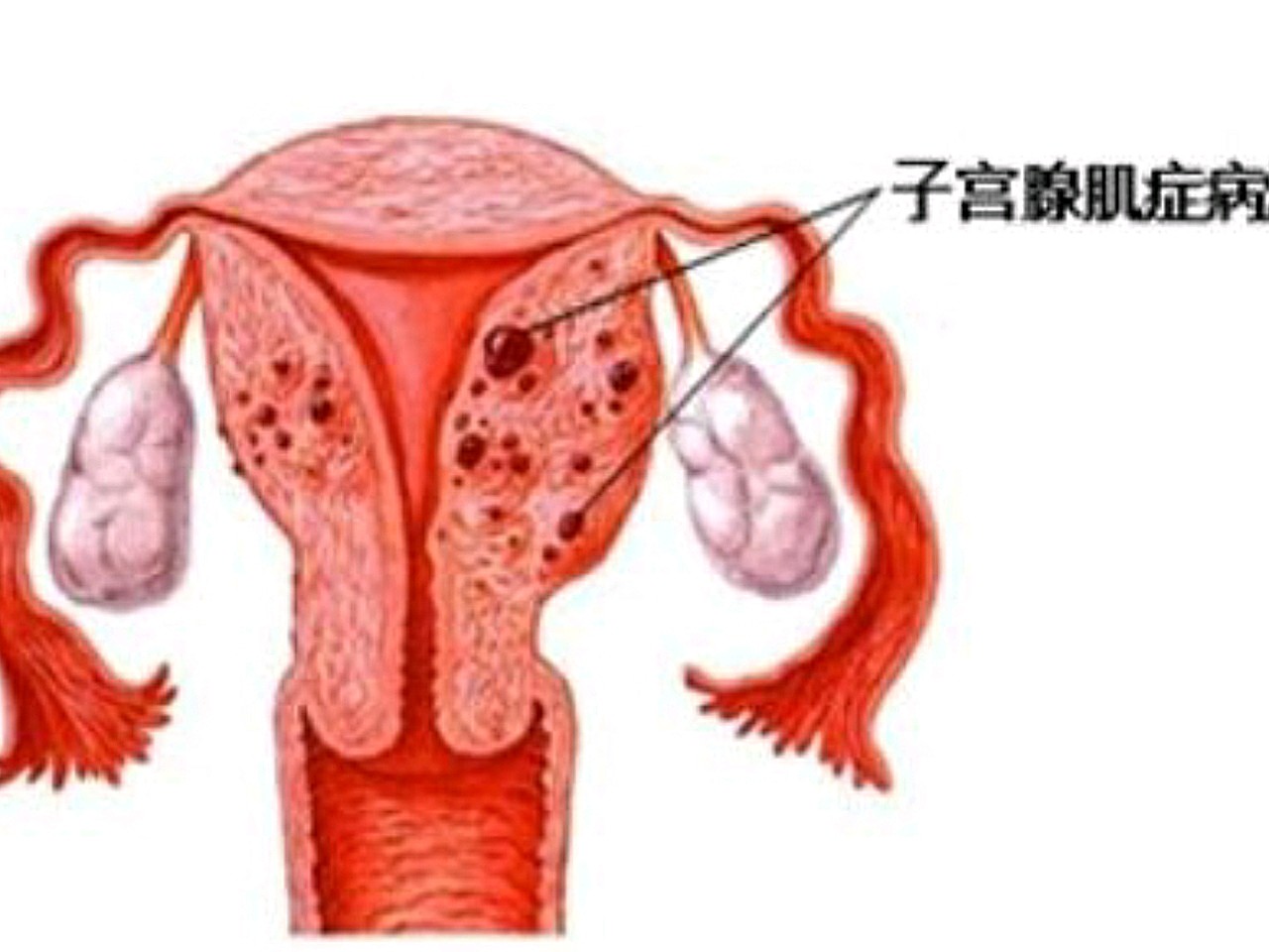 子宫腺肌症会出现子宫增大的情况,主要是因为子宫肌层_圈子-新氧美容