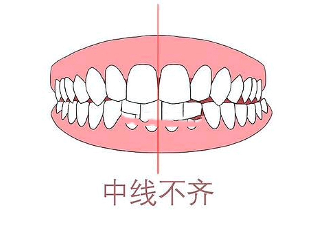 【牙齿中线严重不齐应该怎么办?】