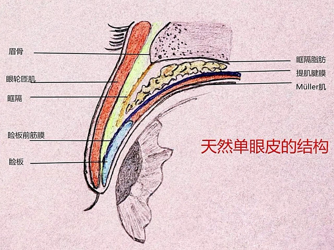 正常的上睑解剖结构从浅层到深层,大致可以分为,皮肤,眼轮匝肌