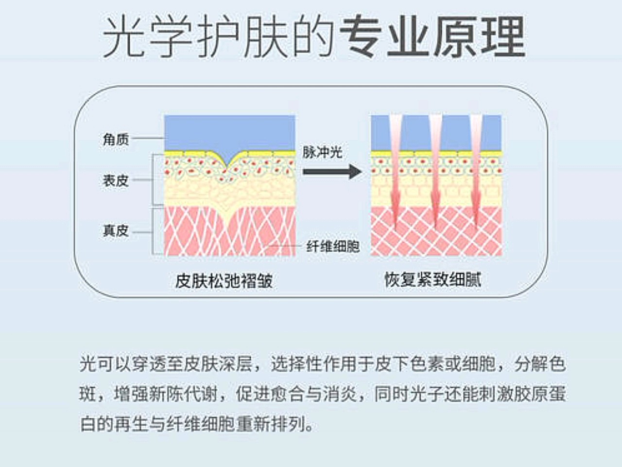 光子嫩肤的原理