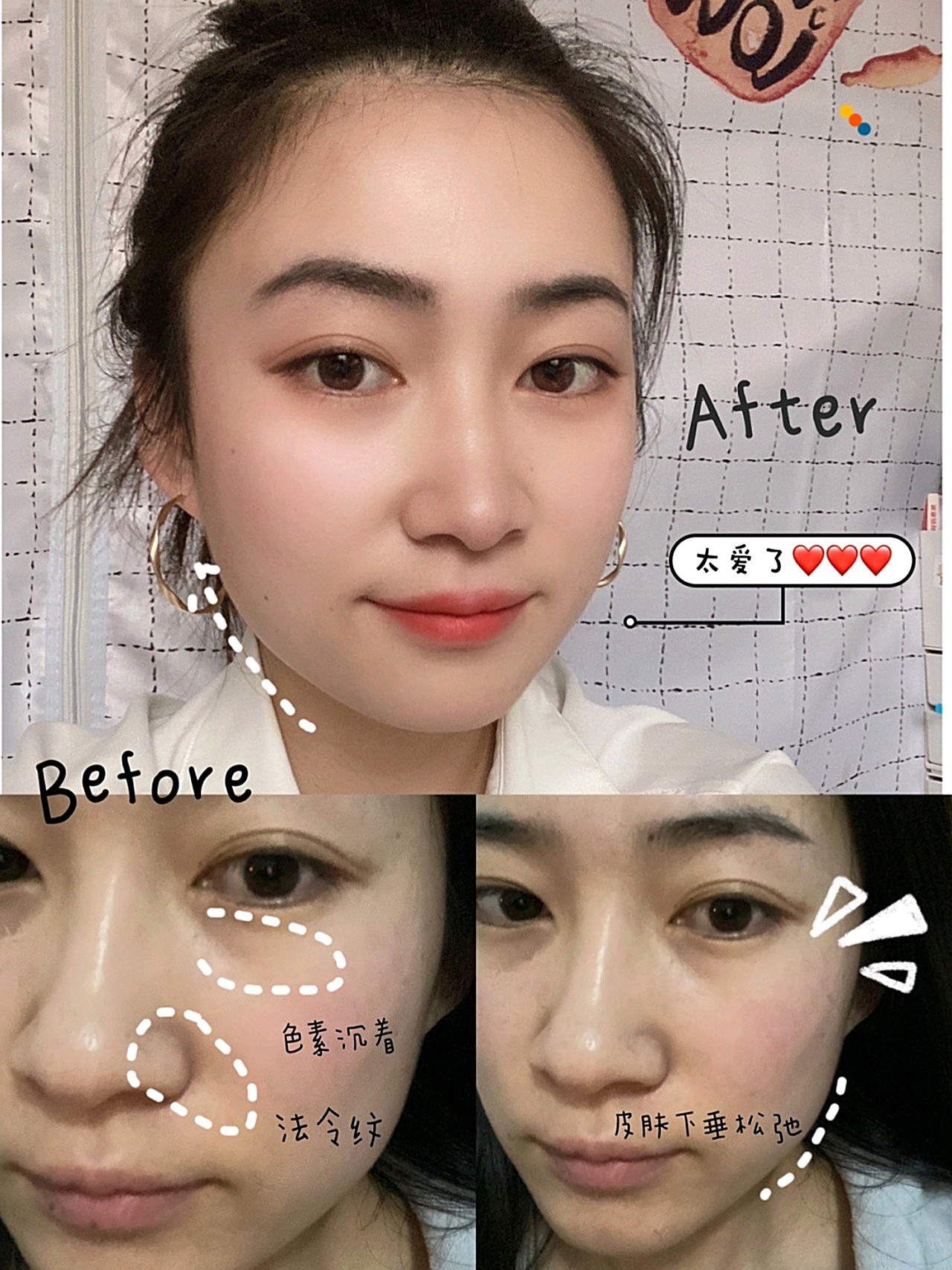 上个月做了欧洲之星fotona4dpro