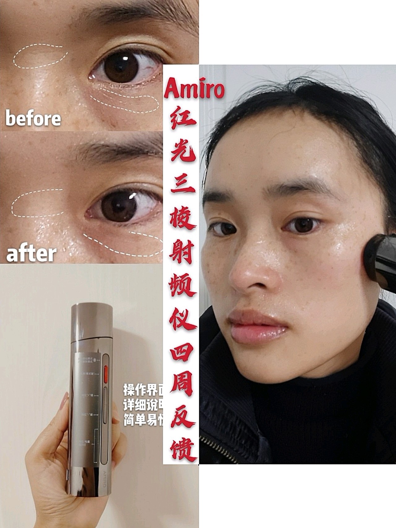 amiro红光三棱射频仪使用四周反馈