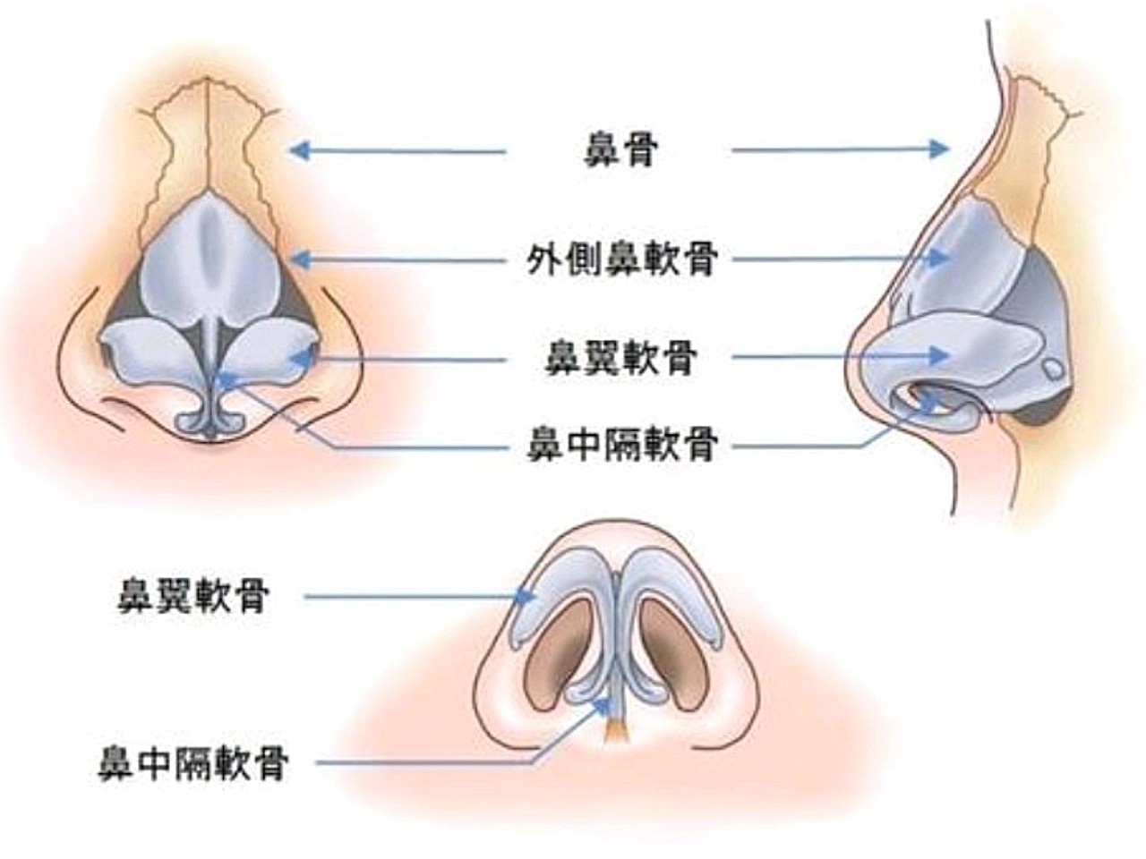 鼻骨内推的恢复期