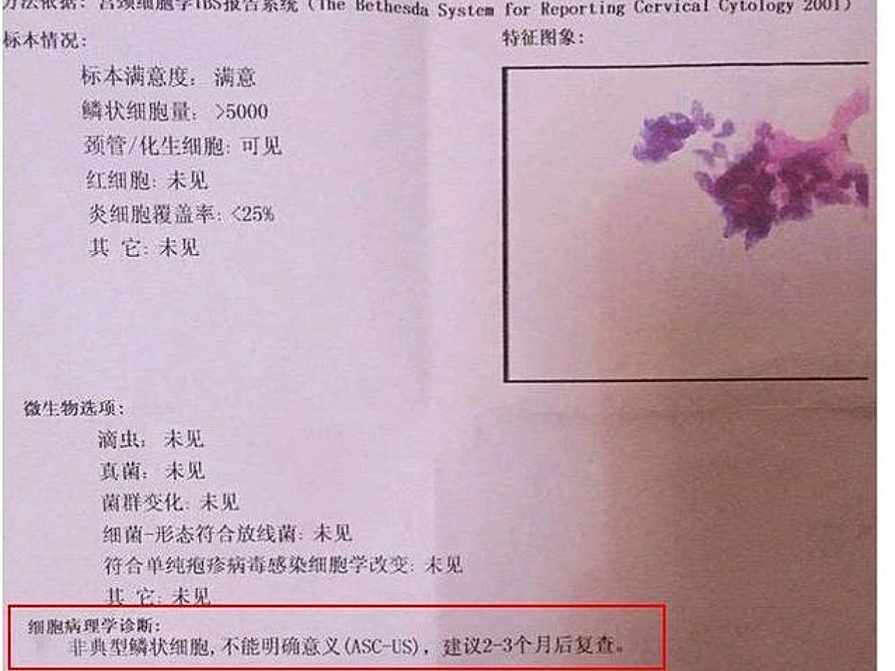 tct检查是液基薄层细胞检测的简称,采用液基薄层细胞检测系统检测宫颈