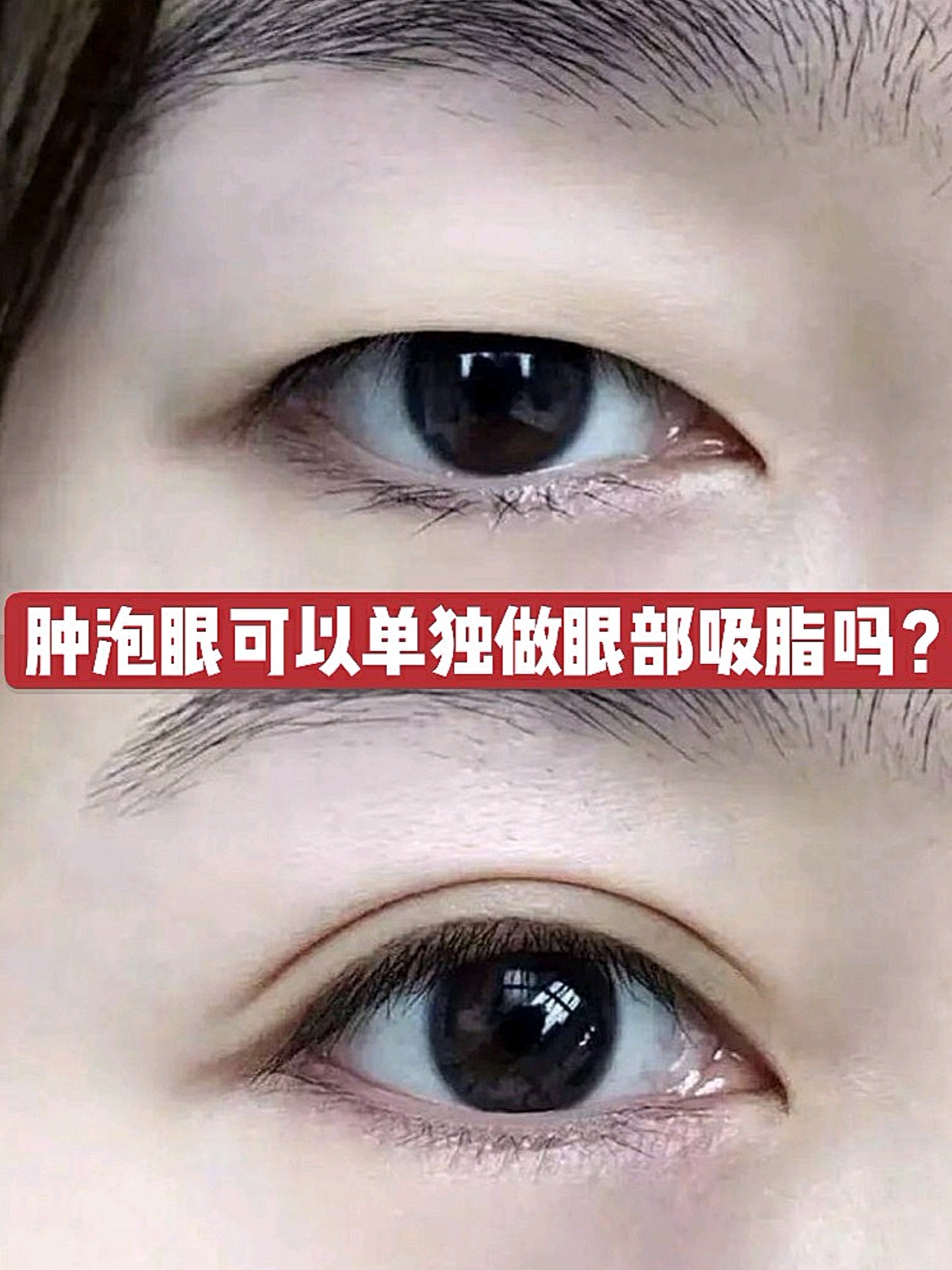 脂肪型肿泡眼可以单独做眼部吸脂吗?