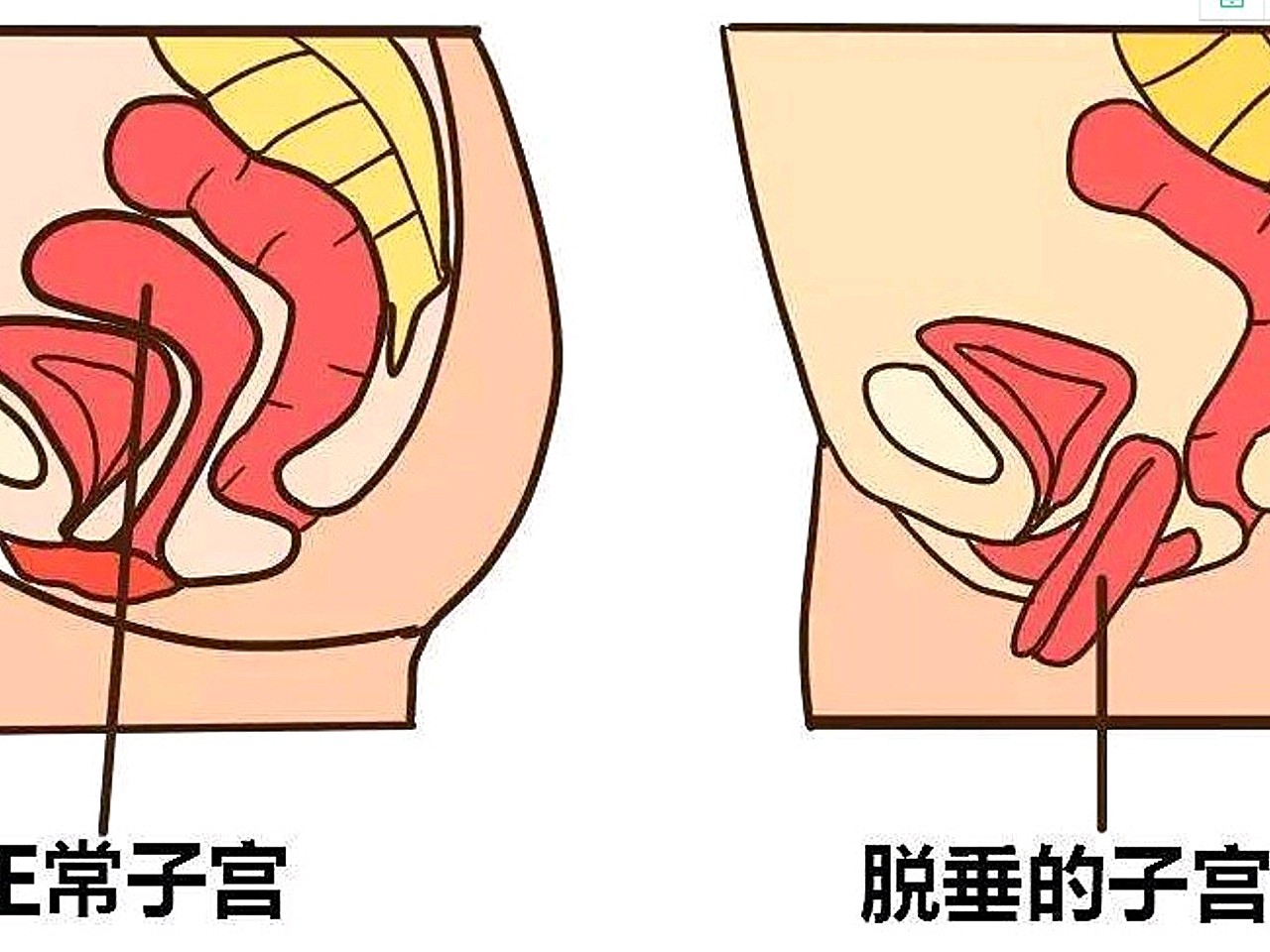 《沈阳省医健康科普》子宫下垂的4点原因