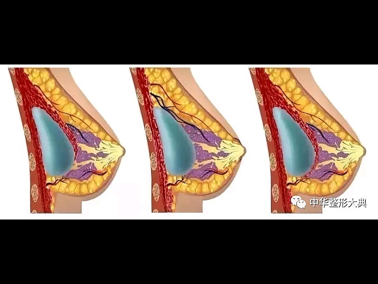 按其囊内容物不同可分为硅凝胶充填型和生理盐水充注型等 按其使用