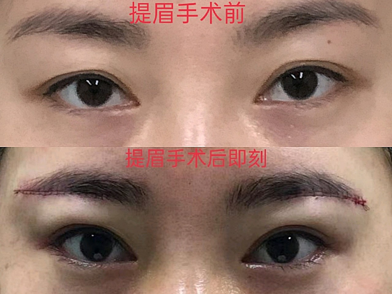 韩式提眉（作为"做过提眉手术"的过来人，这7个真相我"不吐不快"） | 说明书网