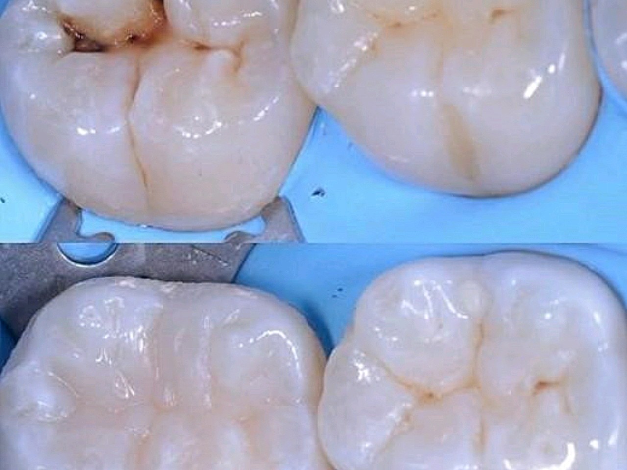 下面再分别说说补完这两类材料后的注意复合树脂补牙牙齿充填图片补牙