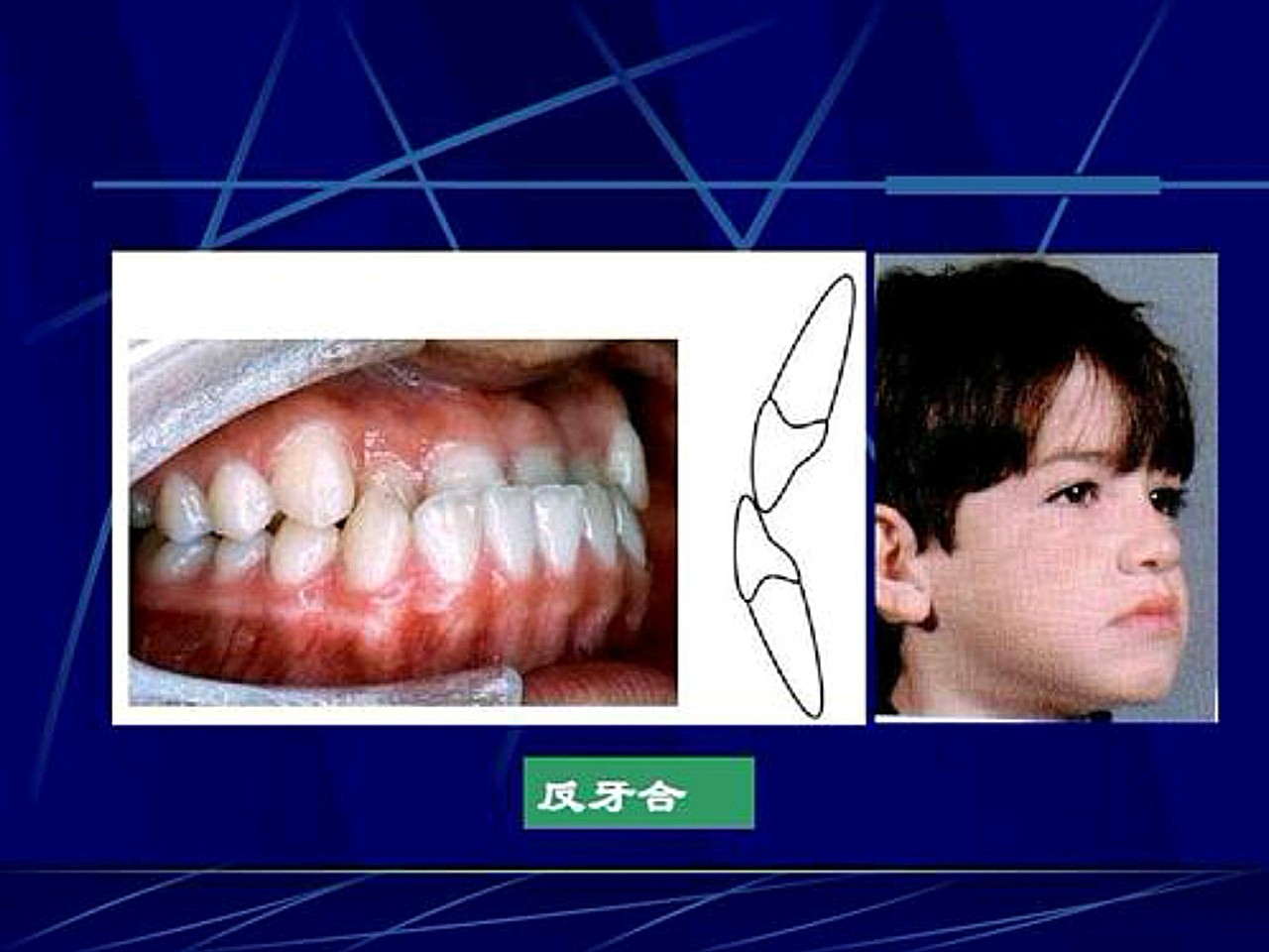 1,上颌牙严重唇向错位或唇向移位,反合牙.