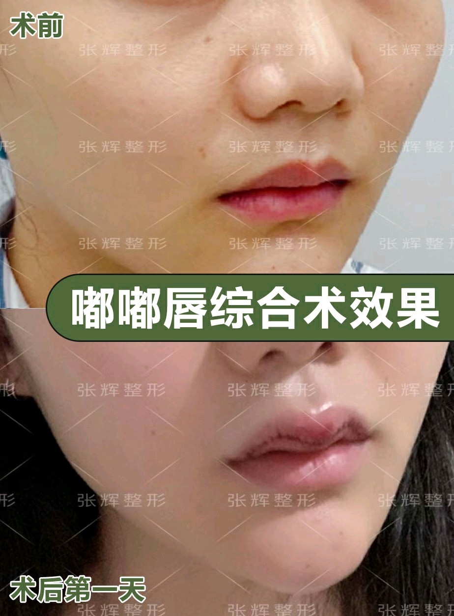【术前诊断】:m唇不明显【方案设计】:首先,我们先观察求美者的唇部