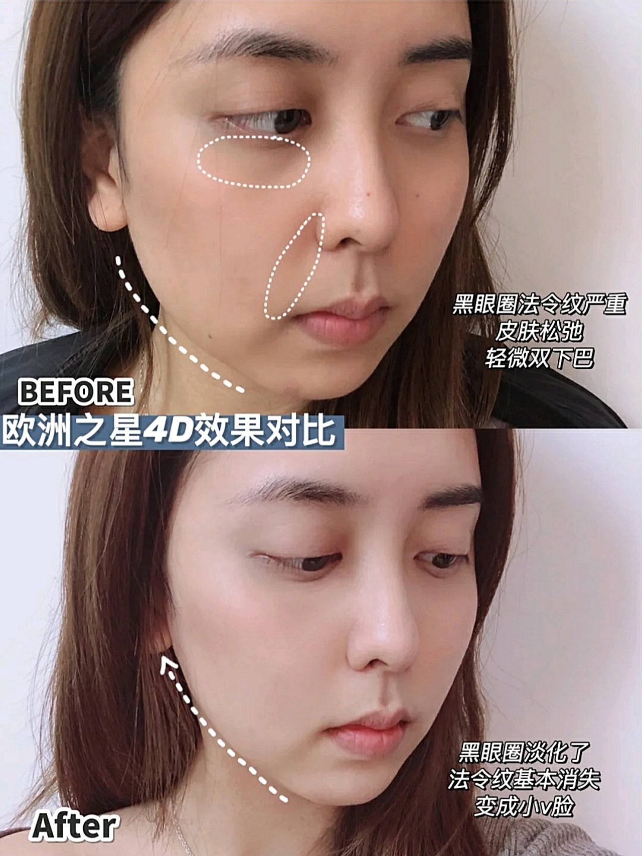 欧洲之星对抗黑眼圈效果如何亲测有效