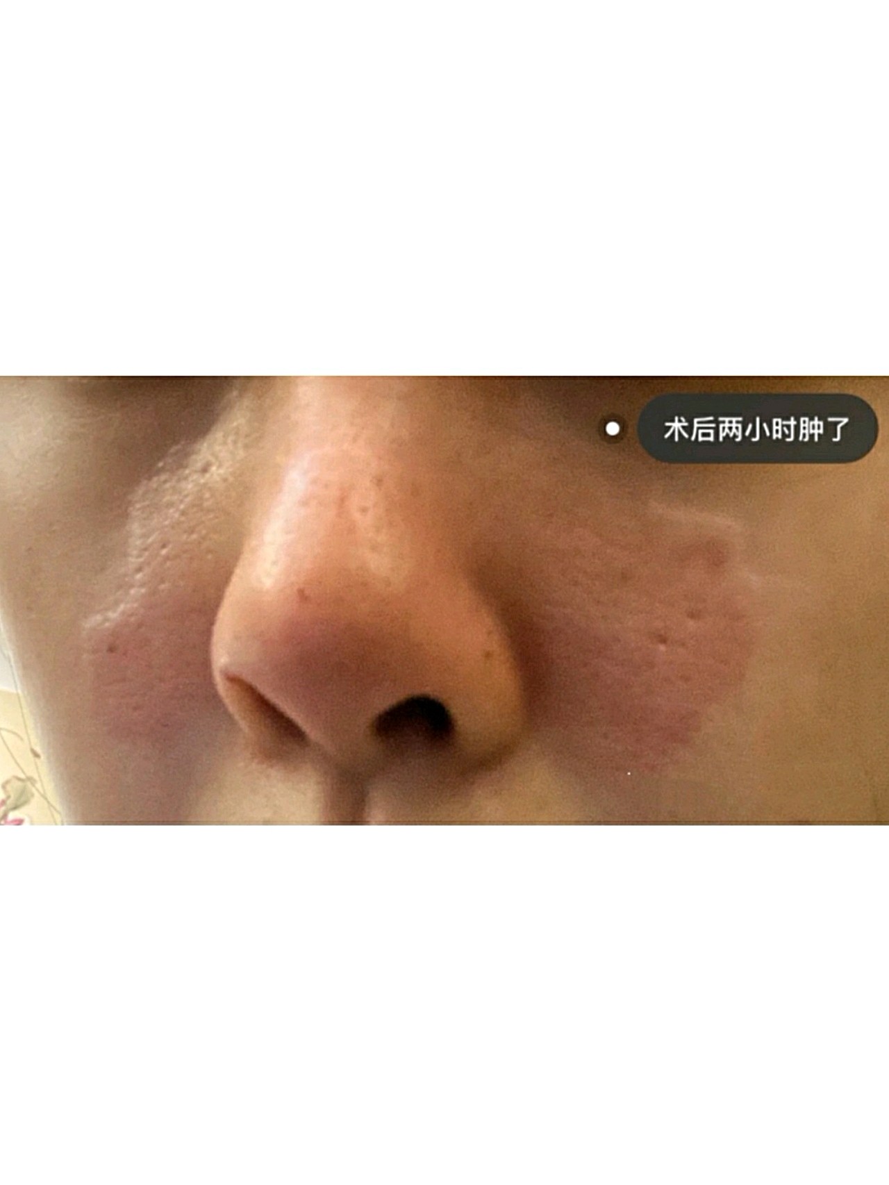 主要是因为备婚,觉得鼻子细致毛孔粗大而且鼻梁上有一道红色的色素沉