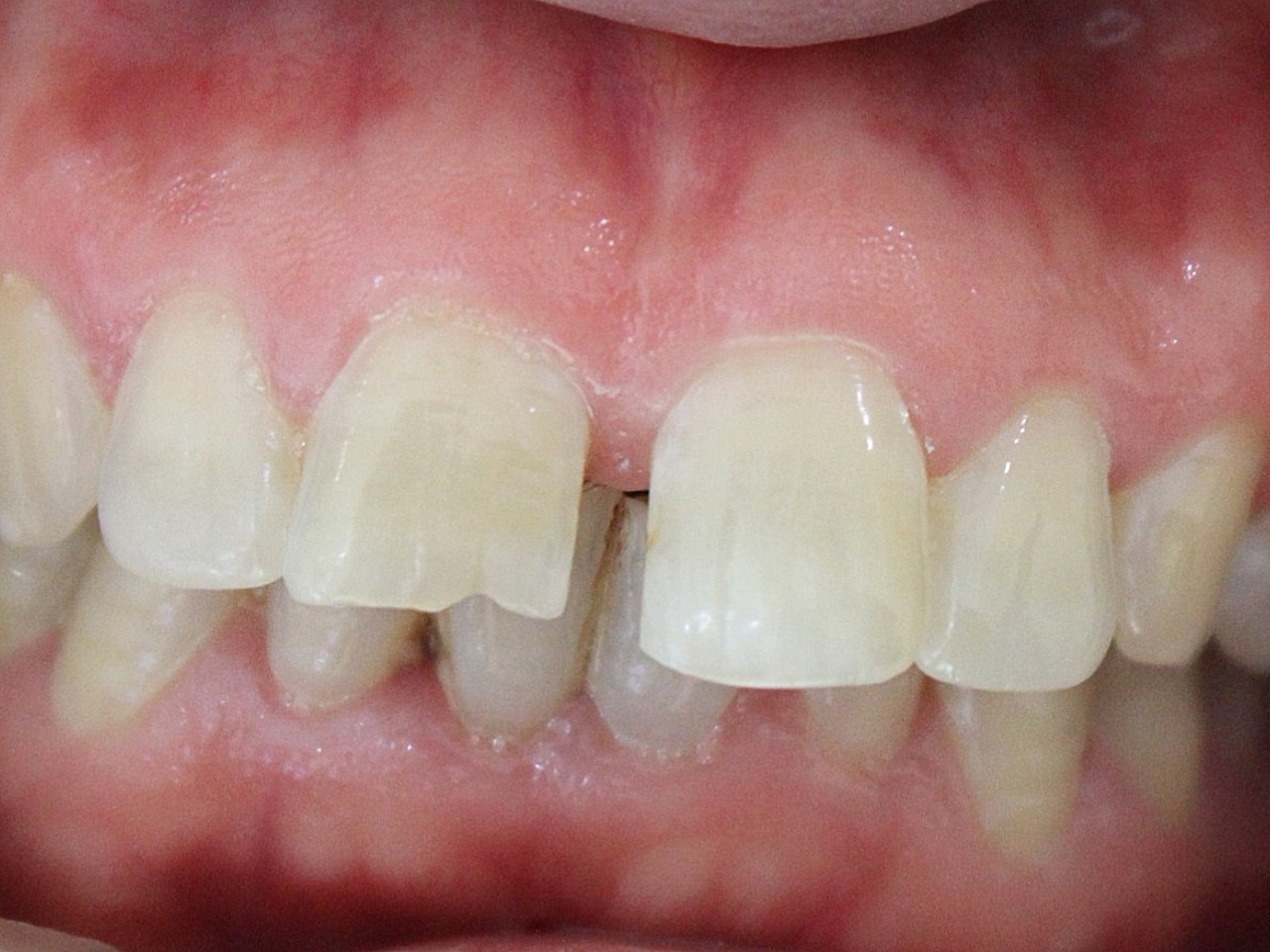一例门牙有缝影响美观的贴面 牙冠修复病例