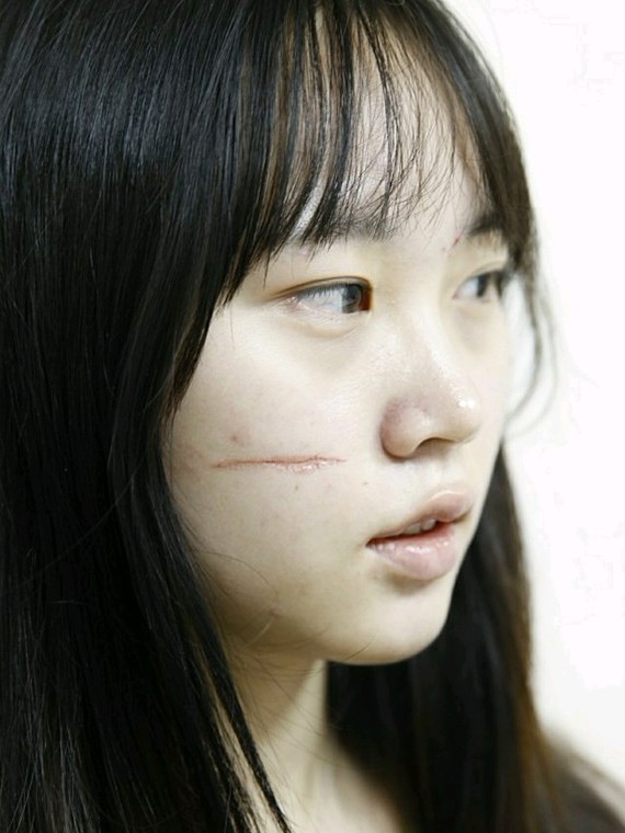 脸上一道划伤疤痕,形态凹凹凸凸的,不仅看着不舒服,_圈子-新氧美容