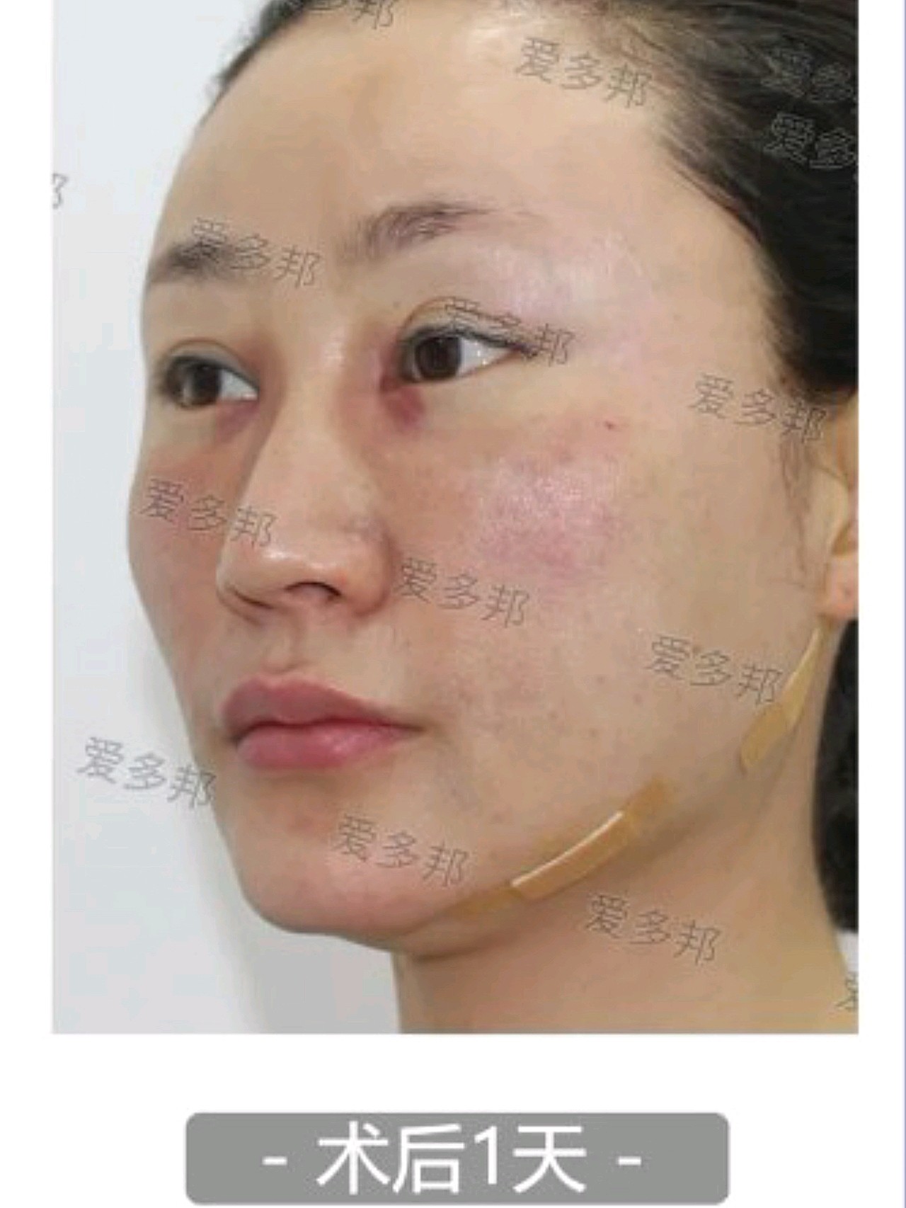 泪沟生长因子取出 苹果肌脂肪修复术后90天反馈!