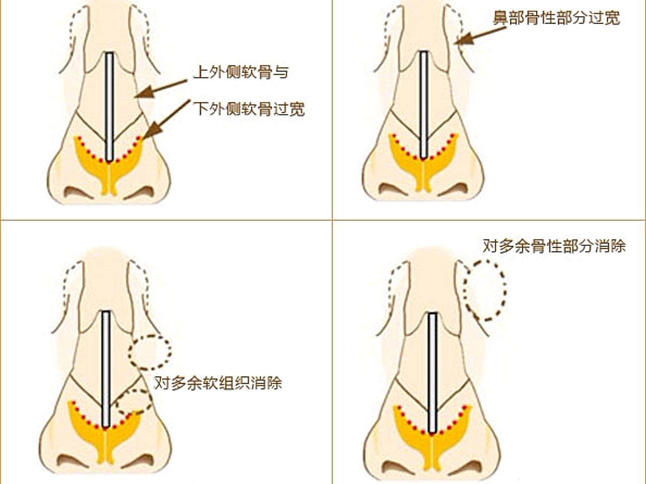 宽鼻主要体现为鼻骨宽和鼻翼宽两种.