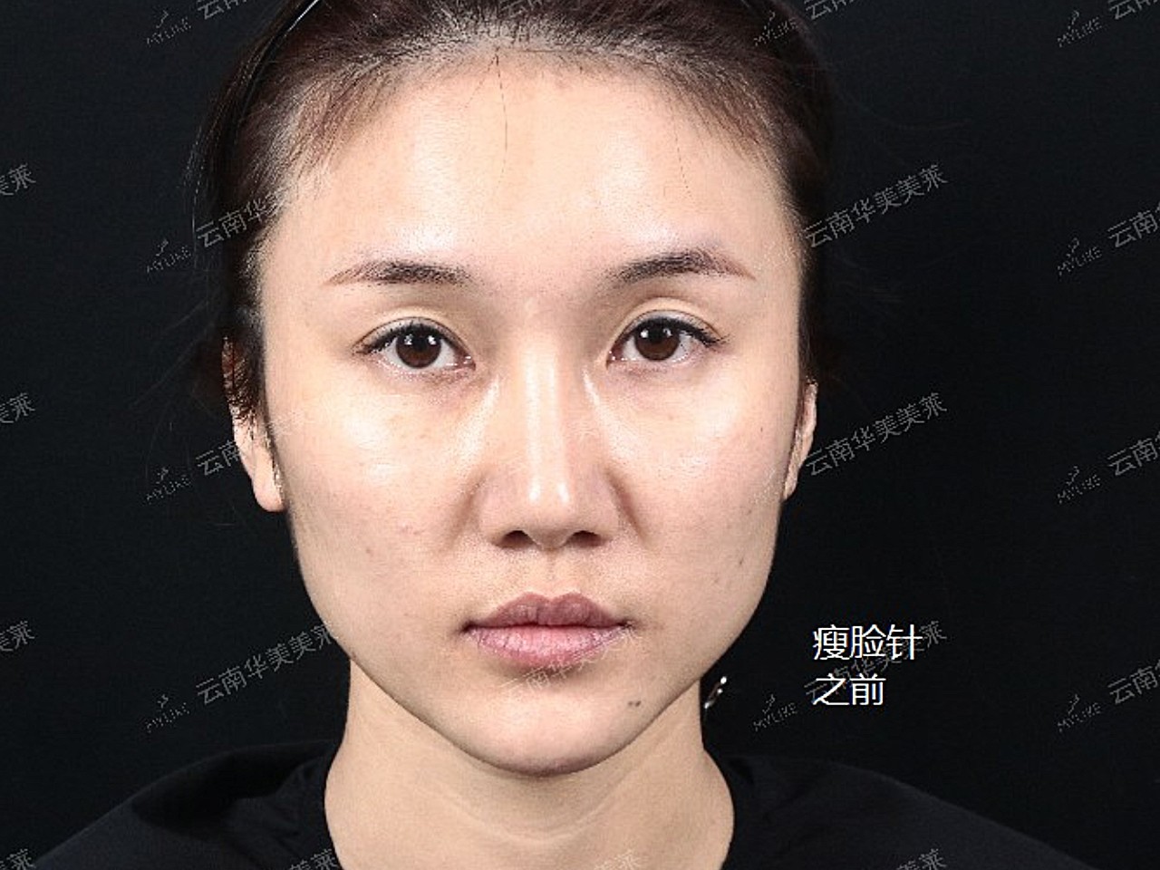 咬肌人人都有,区别在于是肥大还是柔和.柔和的咬肌在