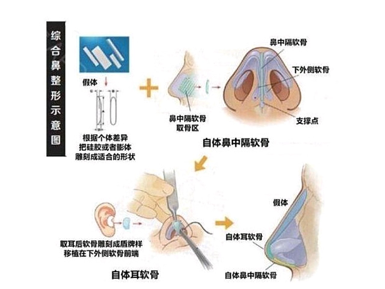 例如垫鼻梁 耳软骨垫鼻尖 鼻头缩小/鼻翼缩窄等,但是现在,业内普遍