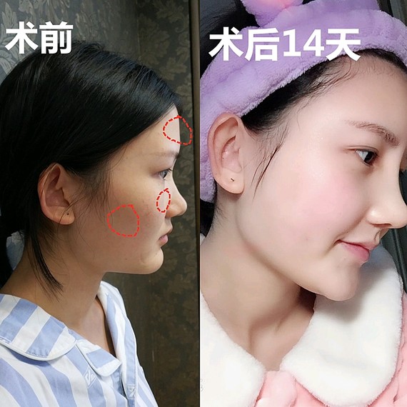 原生问题:  面中凹陷,额头扁平,侧面看起来像月亮脸.