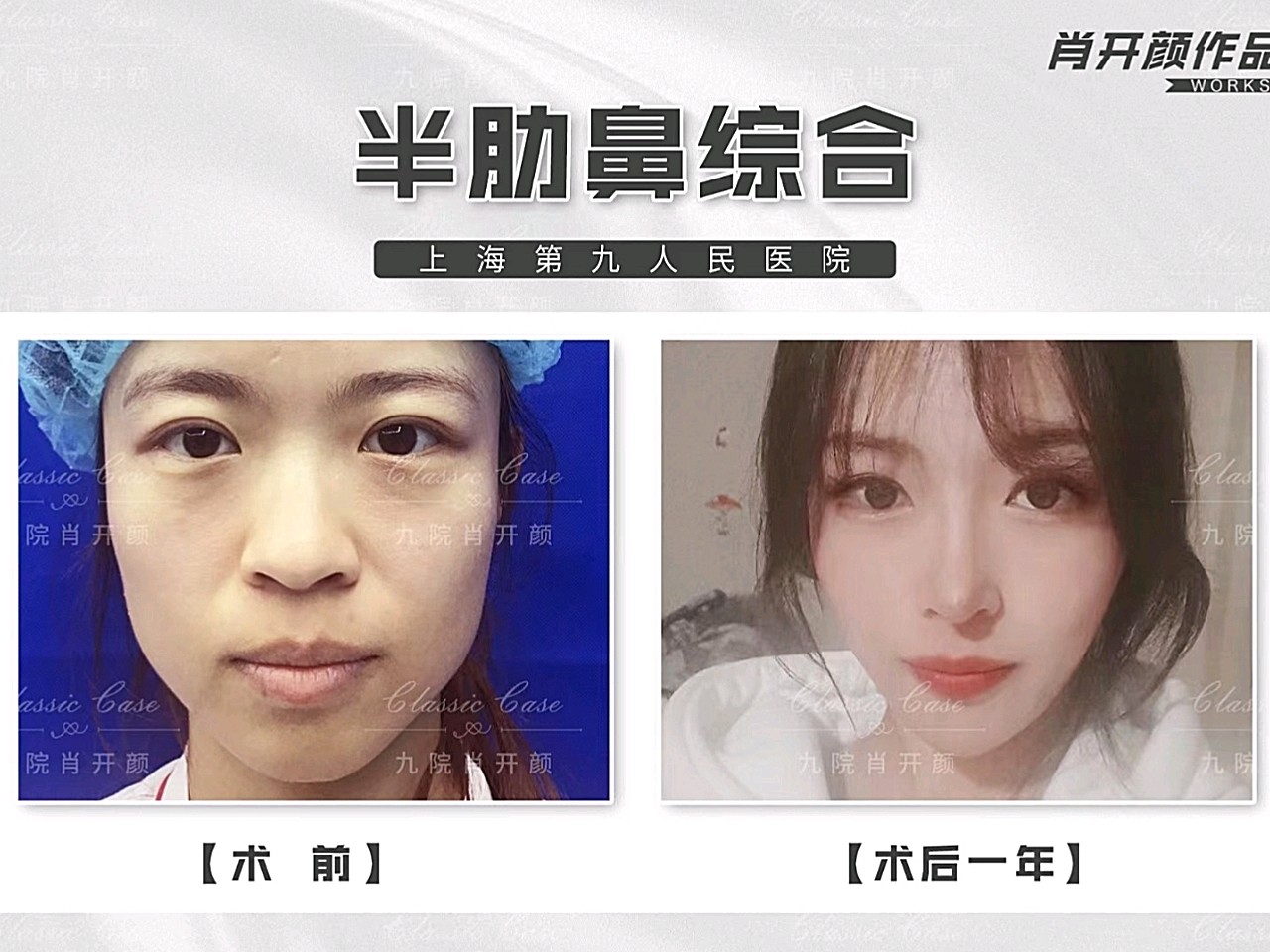 九院肖开颜鼻整形#半肋鼻部多项|术后1年求美