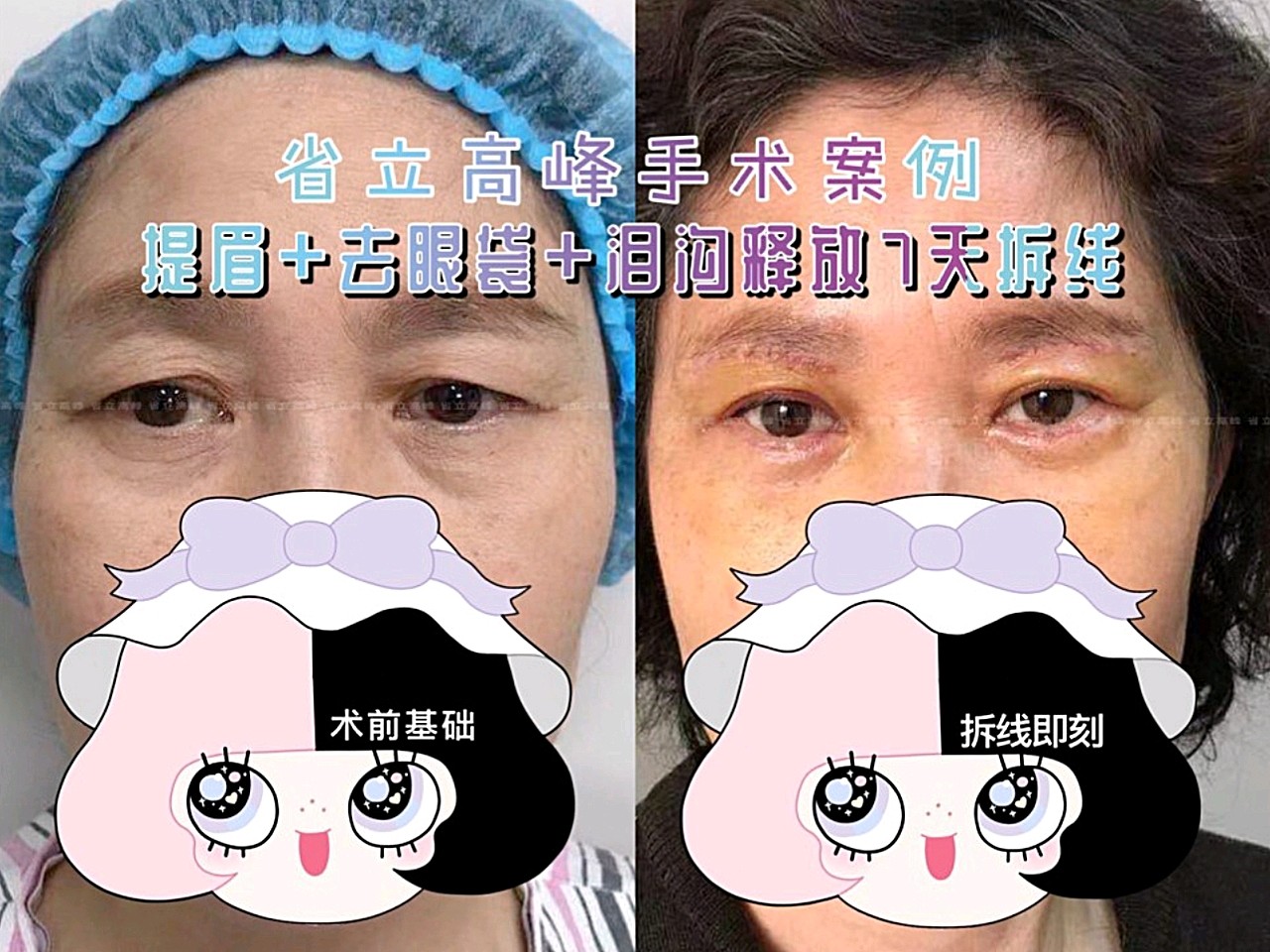 提眉 眶隔释放术后七天拆线