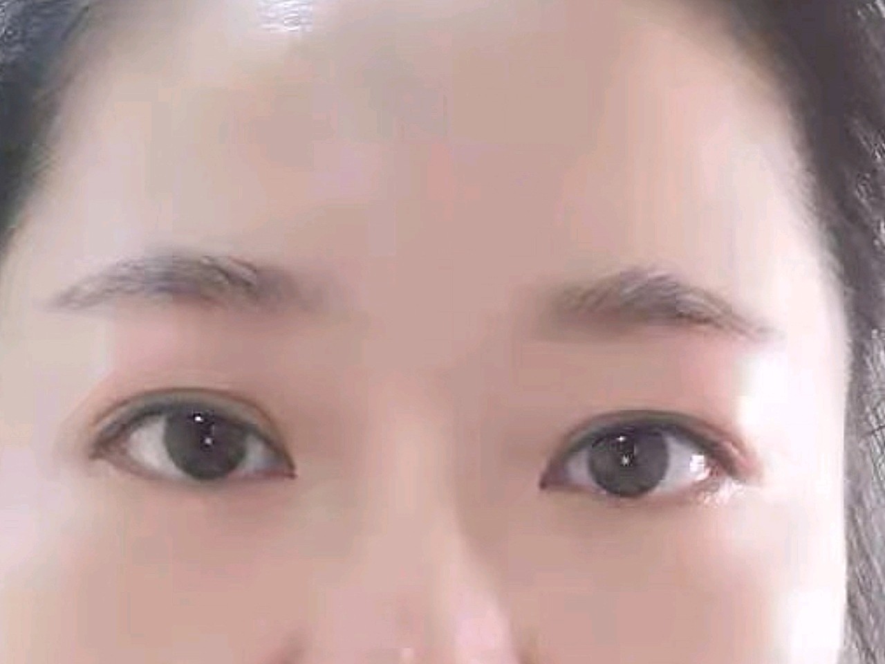 上眼皮松弛下垂怎么办?提眉手术可以直接解决这个问题