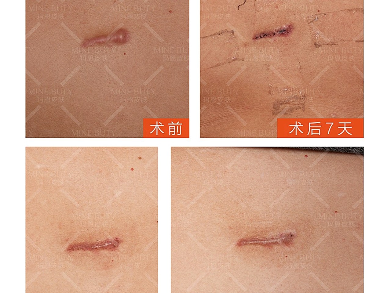 【疤痕科普】缝针疤痕为什么会增生?