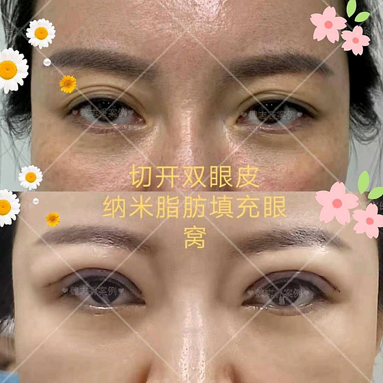 多层双眼皮不好看怎么办看图