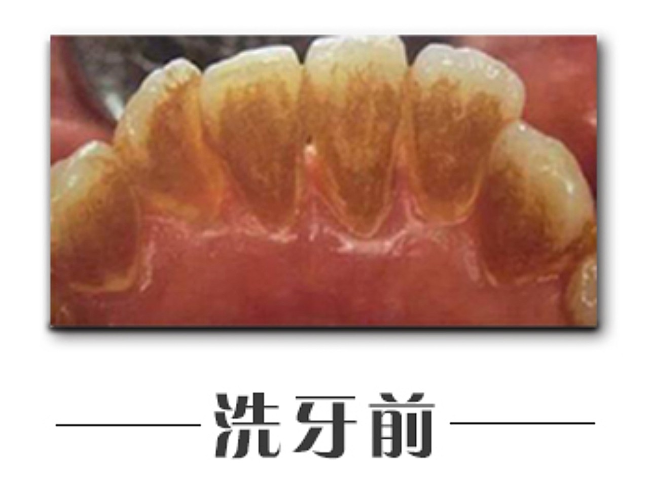 长期吸烟牙齿色素沉着,在牙齿表面形成斑块