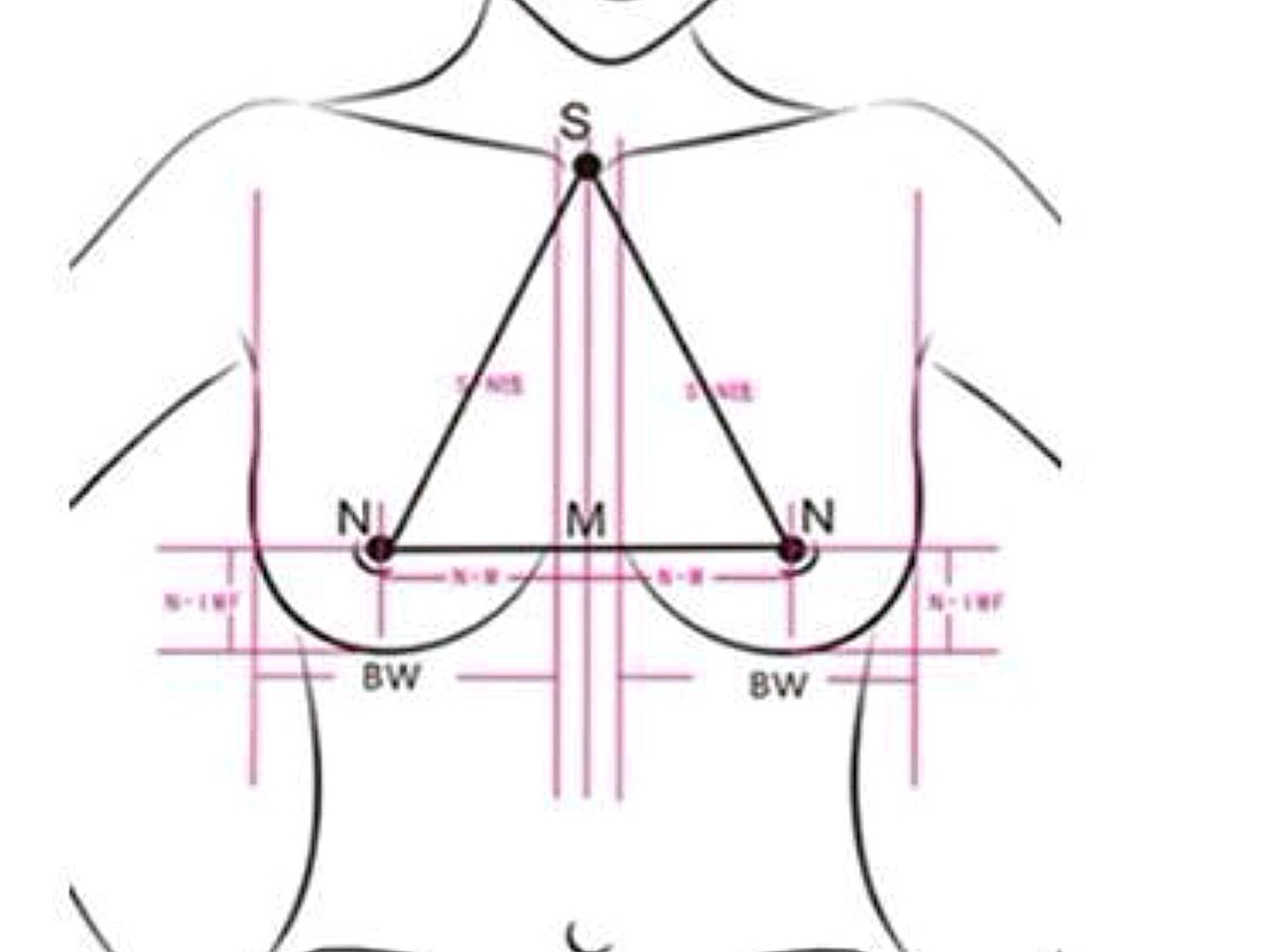 乳头的位置落于肩膀及手肘的中间,且两锁骨中点和两乳