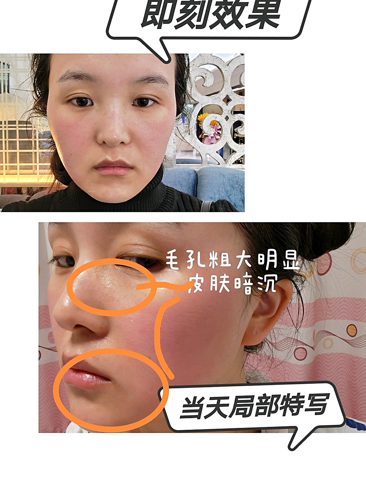 可丽金星光微针一