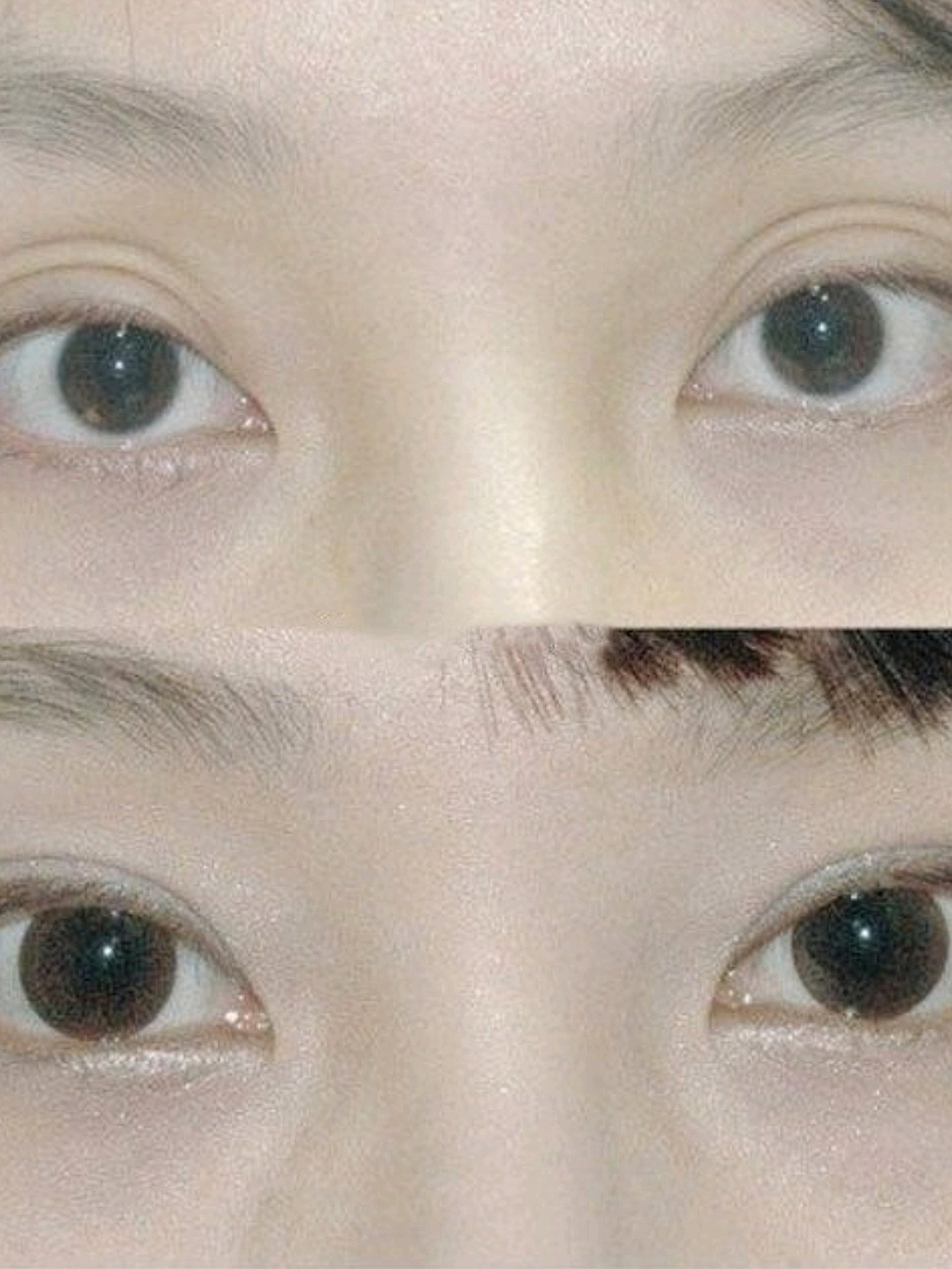 如果直接做双眼皮,容易变成多眼皮,还会加重眼凸的程度.
